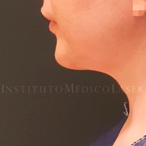 Antes y después de Vaser Lipo y Renuvion en papada