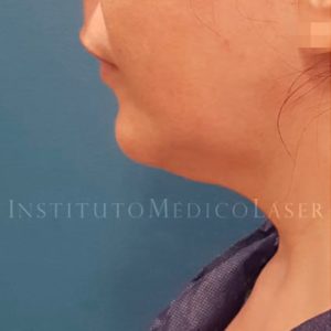 Antes y después de Vaser Lipo y Renuvion en papada