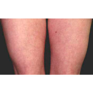 Antes y después del tratamiento de la celulitis