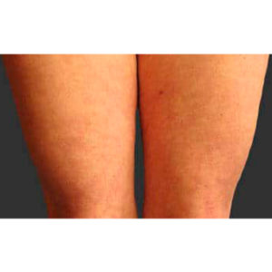 Antes y después del tratamiento de la celulitis