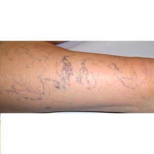 Foto antes y después del tratamiento de varices