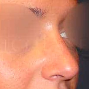 Rinomodelación en dorso nasal, antes y después