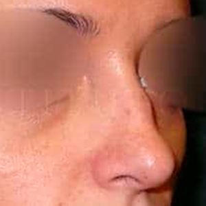 Rinomodelación en dorso nasal, antes y después