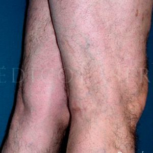 Antes y después de varices en piernas