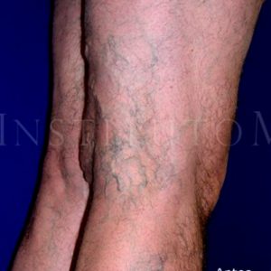 Antes y después de varices en piernas