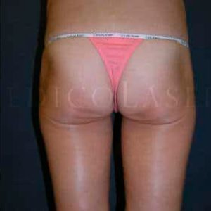 Antes y después de Exilis Elite en glúteos