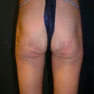 Antes y después de Exilis Elite en glúteos