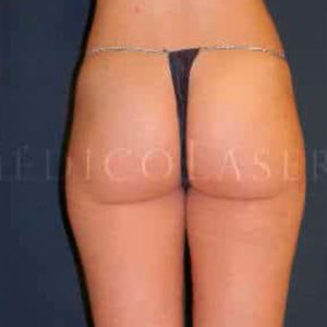 Liposucción láser en cartucheras en IML (Madrid). Antes y después.