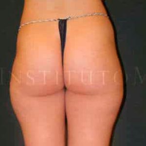 Liposucción láser en cartucheras en IML (Madrid). Antes y después.