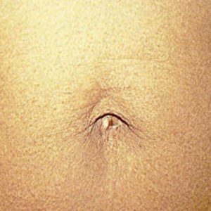 Abdomen, antes y después