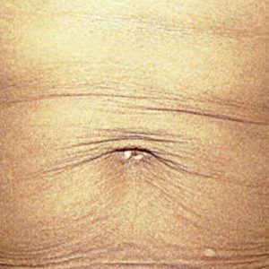 Abdomen, antes y después