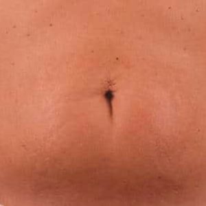Antes y después de la radiofrecuencia Exilis Elite en abdomen