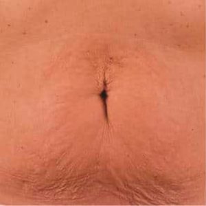 Antes y después de la radiofrecuencia Exilis Elite en abdomen