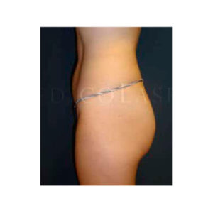 Reducción de grasa abdominal, antes y después