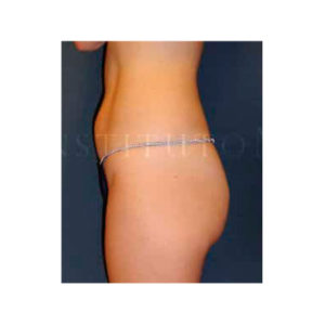 Reducción de grasa abdominal, antes y después