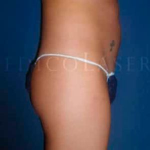 Antes y después de Vanquish ME en abdomen