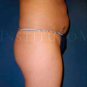 Antes y después de Vanquish ME en abdomen