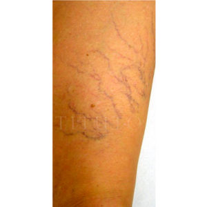 Antes y después de tratar arañas vasculares con Terapia Fotodinámica