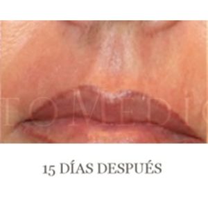 Antes y después de eliminar arrugas en la boca con CO2