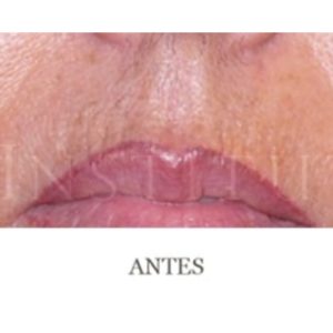 Antes y después de eliminar arrugas en la boca con CO2