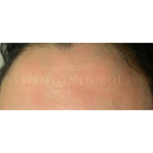 Tratamiento para arrugas en la frente (antes y después)