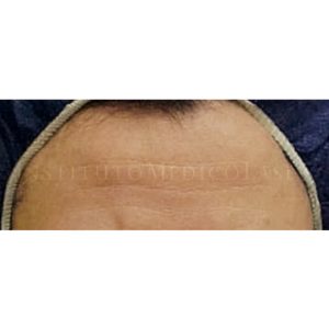 Tratamiento para arrugas en la frente (antes y después)