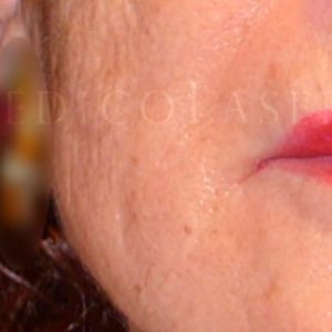 Tratamiento para eliminar arrugas en los ojos, antes y después