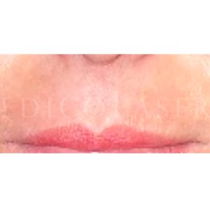 Antes y después de eliminar el código de barras en labios