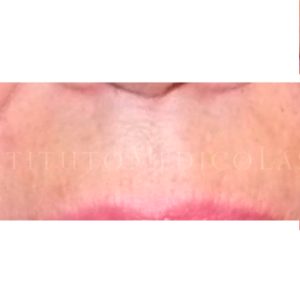 Imágenes del tratamiento de arrugas peribucales (Antes y después)