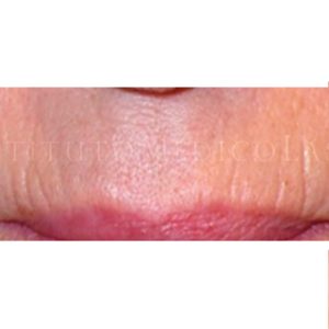 Imágenes del tratamiento de arrugas peribucales (Antes y después)