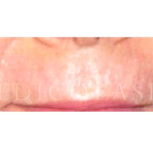 Antes y después de eliminar arrugas verticales en labios