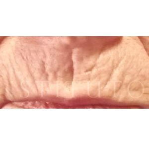 Antes y después de eliminar arrugas verticales en labios