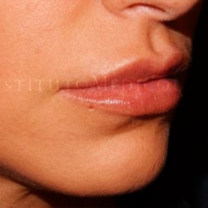 Antes y después del Aumento de labios en IML