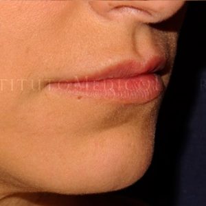 Antes y después del Aumento de labios en IML