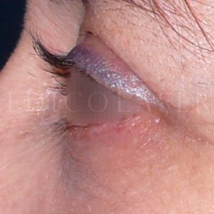 Antes y después de una Blefaroplastia y Resurfacing