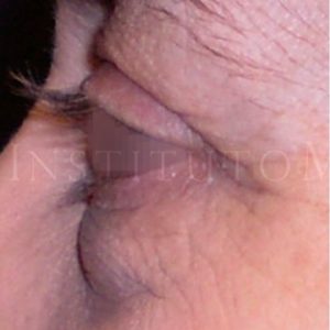 Antes y después de una Blefaroplastia y Resurfacing