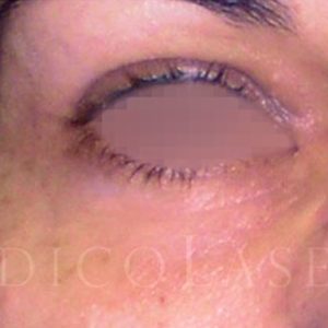 Antes y después del tratamiento Blefaroláser con relleno de ojera