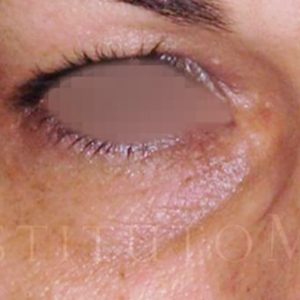 Antes y después del tratamiento Blefaroláser con relleno de ojera