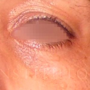 Antes y después del tratamiento de Blefaroláser y Nanofat