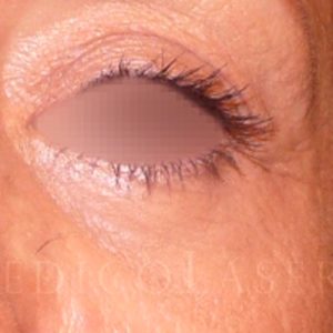 Blefaroplastia en los cuatro párpados (antes y después)