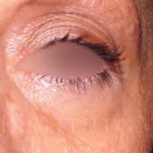 Blefaroplastia en los cuatro párpados (antes y después)