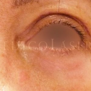 Antes y después de la operación de párpados (Blefaroplastia)
