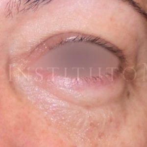 Antes y después de la operación de párpados (Blefaroplastia)