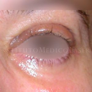 Pre y post tratamiento de Blefaroplastia completa con láser de CO2