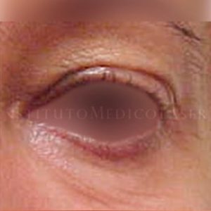 Pre y post tratamiento de Blefaroplastia completa con láser de CO2