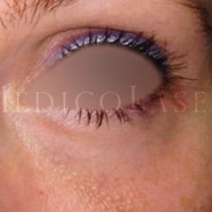 Resultados del antes y después de una Blefaroplastia inferior