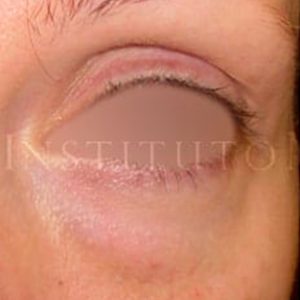 Resultados del antes y después de una Blefaroplastia inferior