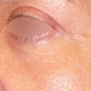 Antes y después de Blefaroplastia láser completa en IML