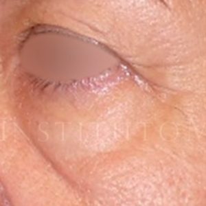 Antes y después de Blefaroplastia láser completa en IML