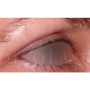 Blefaroplastia láser en Madrid, fotos del antes y después
